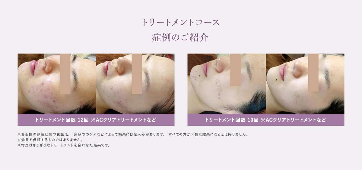 ACクリアトリートメントコースについて※トリートメントコース一例
