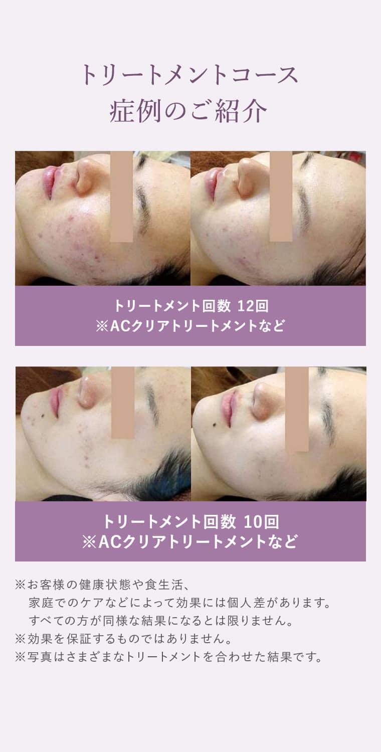 ACクリアトリートメントコースについて※トリートメントコース一例