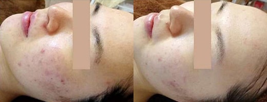 ACクリアトリートメントコースについて※トリートメントコース一例